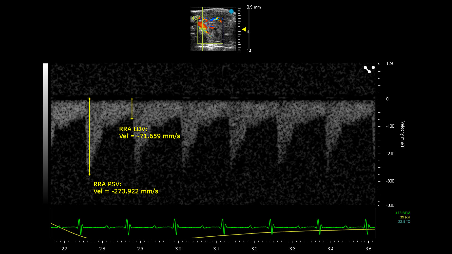 PW Doppler measurements for renal artery flow