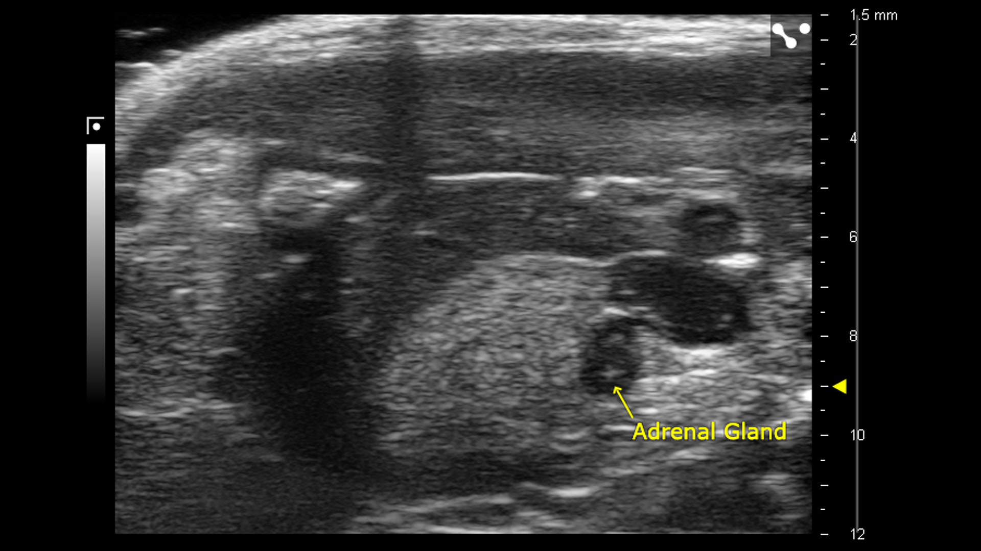 B-mode of the right adrenal gland