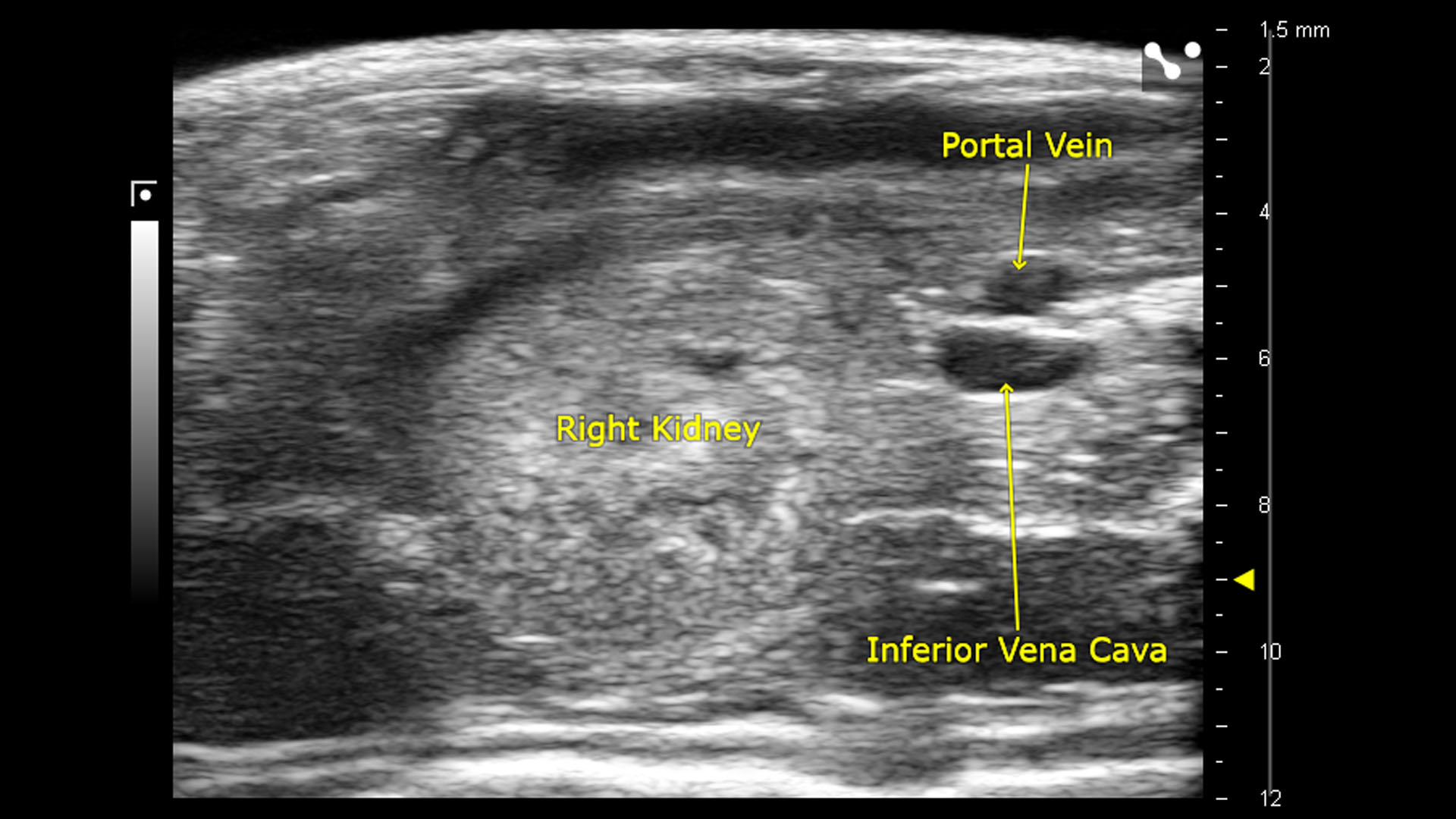 B-mode of the right kidney, portal vein, and inferior vena cava