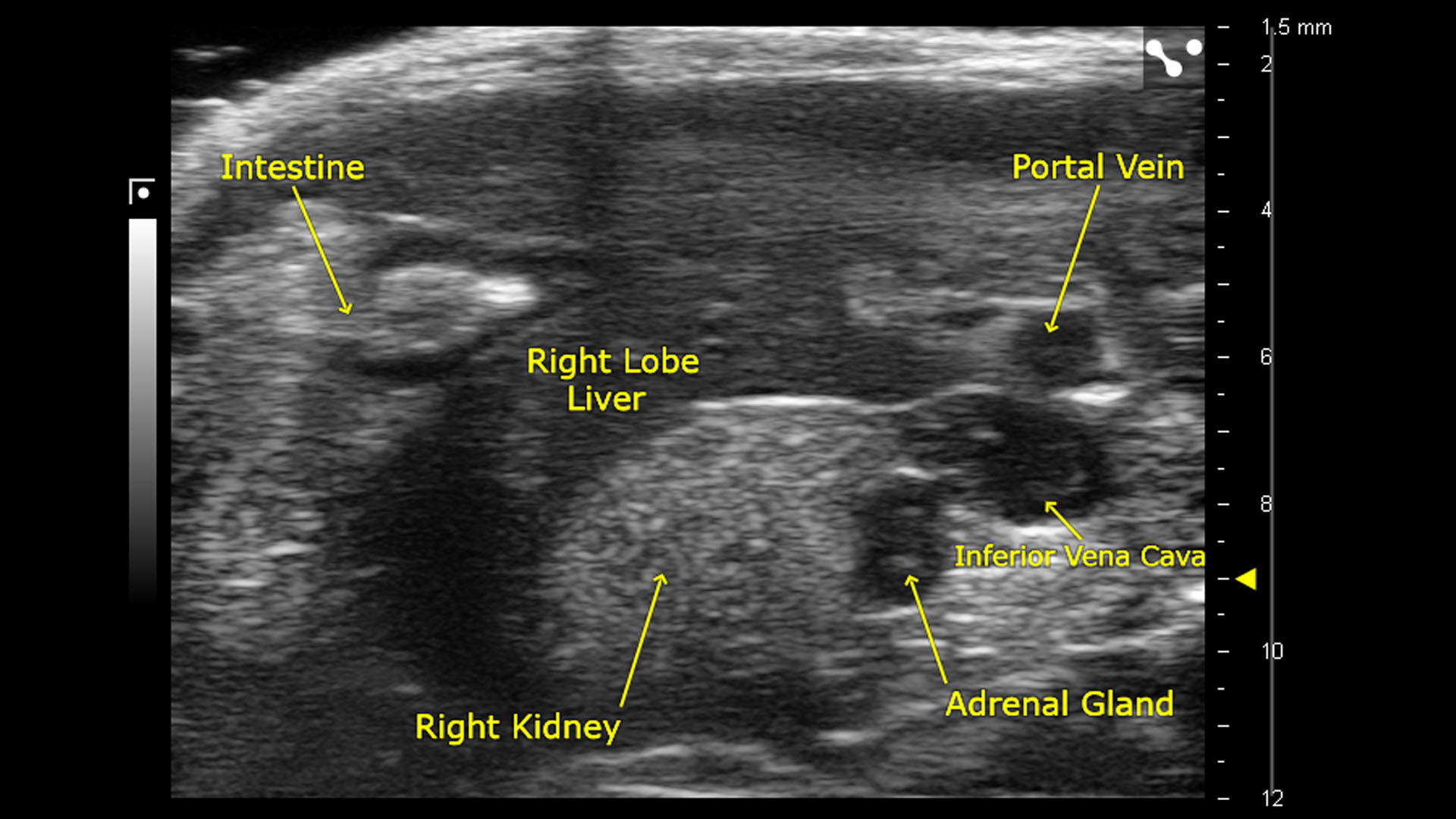 B-mode of intestine, right kidney, right lobe liver, portal vein, inferior vena cava, and adrenal gland