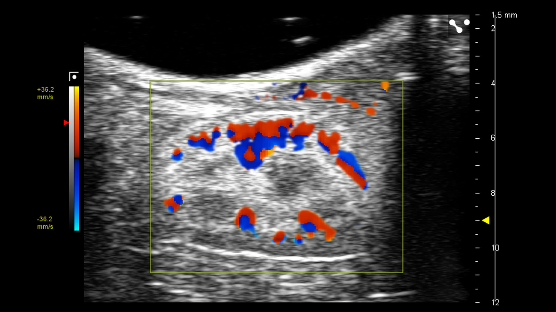 Color Doppler of the sagittal view in the left kidney