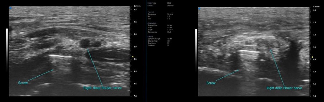 Deep Fibular Neuropathy on Post-surgical screw.jpg