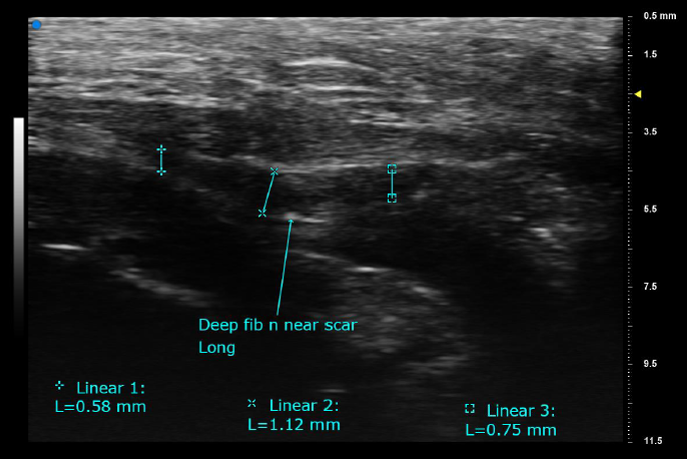 Facilitates delineation and measurement of small changes - fibular nerve-cropped.png
