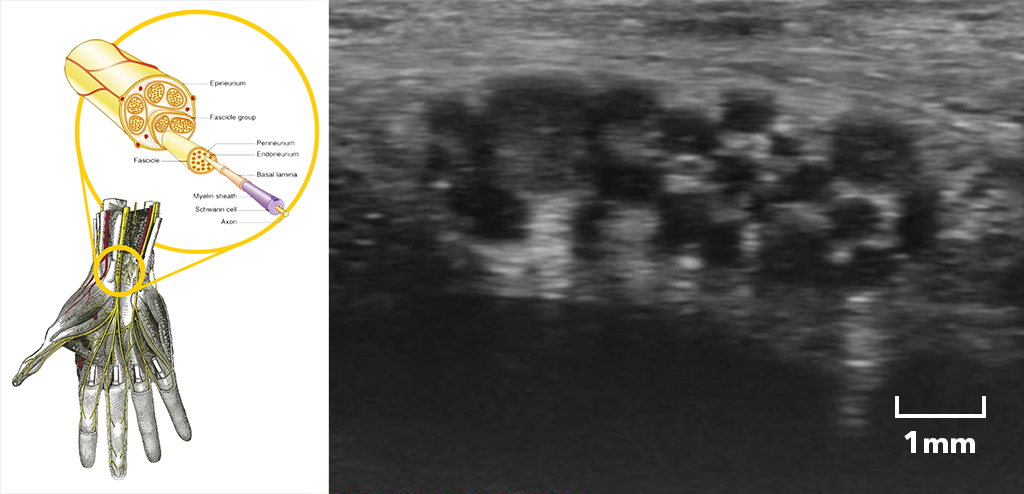 Researcher Spotlight - Median Nerve.png