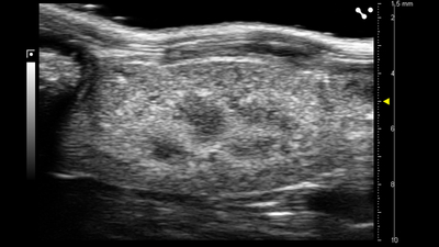 B-mode of the sagittal kidney