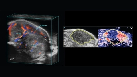 Pancreatic Tumors