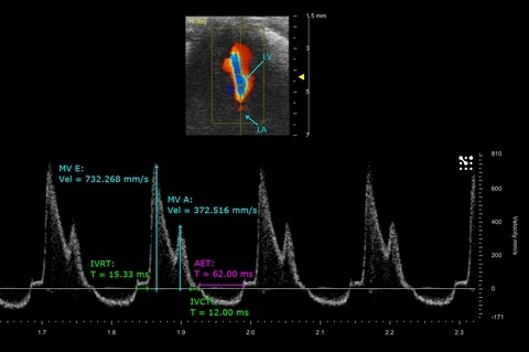 Mitral PW PND 9 E & A