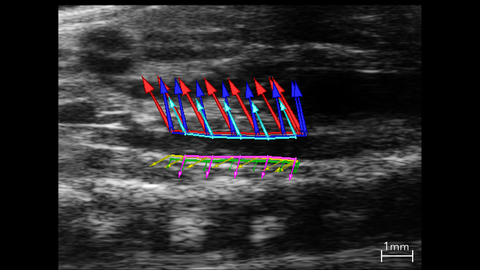 B-mode image of the abdominal aorta with vessel wall velocity vector arrows used in strain analysis