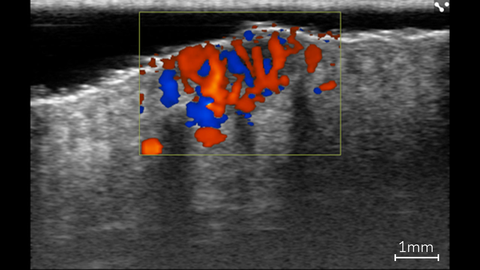 Color Doppler showing blood flow within a basal cell carcinoma lesion in a patient using ultra high frequency ultrasound on the Vevo MD.