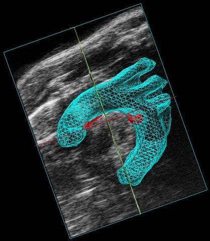 2100-mouse-atherosclerosis-plaque-3D.jpg