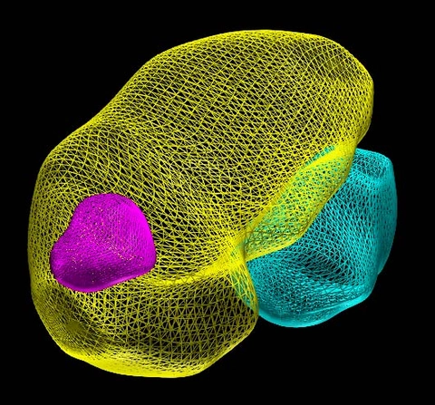 3D-Volume-Left-Kidney-with-Tumors.jpg