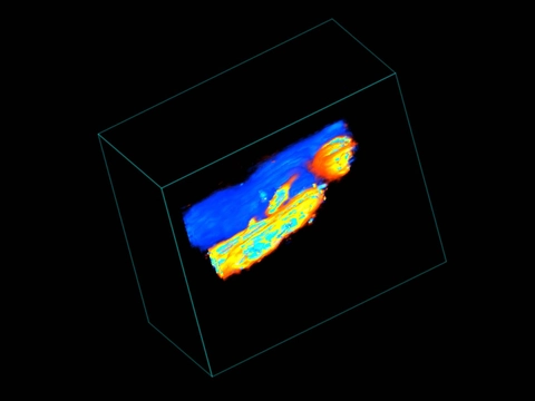 3D color of carotid fistula.jpg