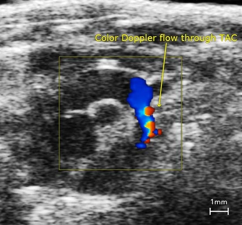 Aortic Arch Following Transaortic Constriction