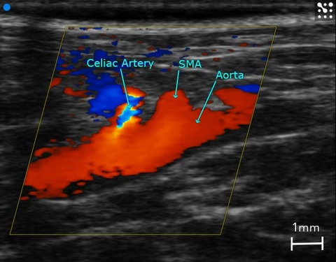 Branching-of-Abdominal-Aorta.jpg