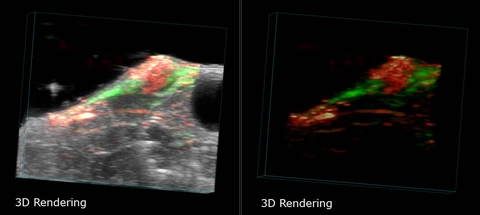 Breast-Cancer-Tumor-in-3D.jpg