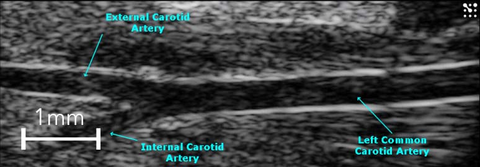 Carotid Artery Bifurcation