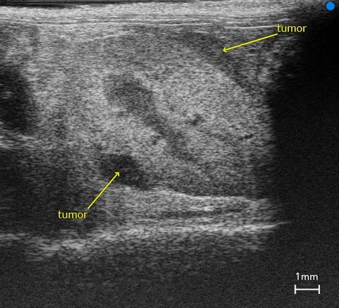 Kidney with Subcapsular Tumor