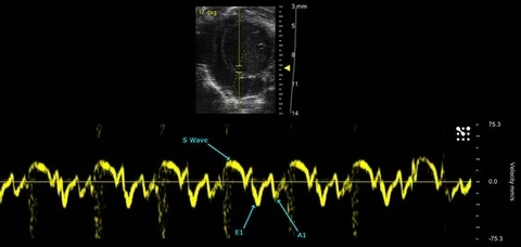 Mitral Tissue Doppler