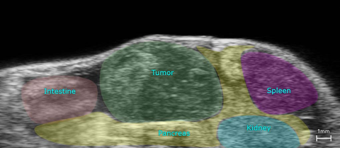 Ortho-panc-tumor-unmix-3D-bmode.jpg