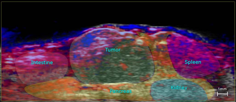 Ortho-panc-tumor-unmix-3D-fusion.jpg