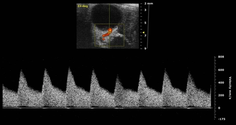 PW uterine artery flow.jpg