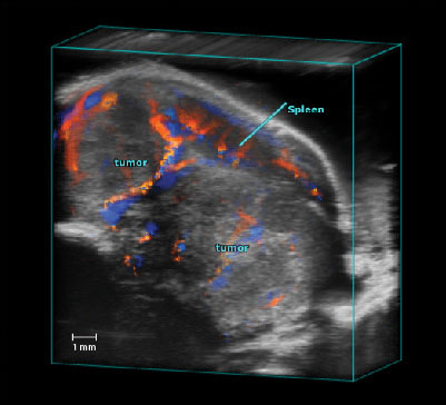 Pancreatic Tumor Color Doppler 3D.jpg