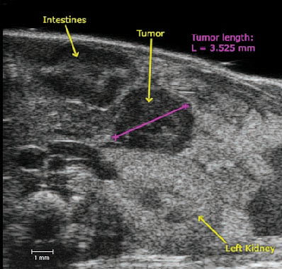 Pancreatic tumor size.jpg