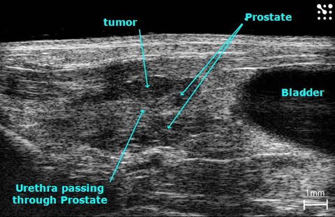 Prostate tumor.jpg