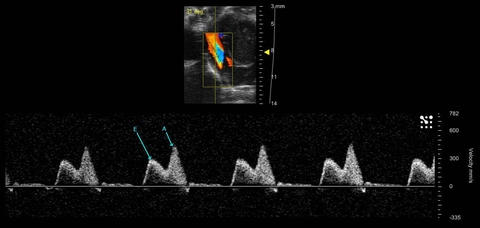 Tricuspid flow mouse annotated