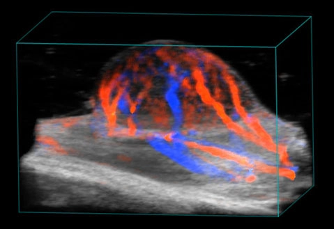 Tumor-Colour-doppler.jpg