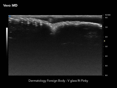 Vevo MD - Dermatology Foreign Body.jpg