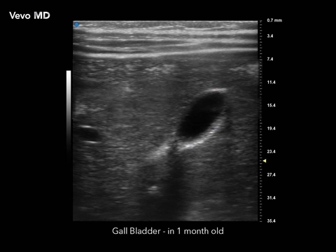 Vevo MD - Gall Bladder.jpg