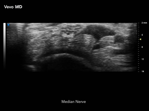 Vevo MD - Median Nerve.jpg