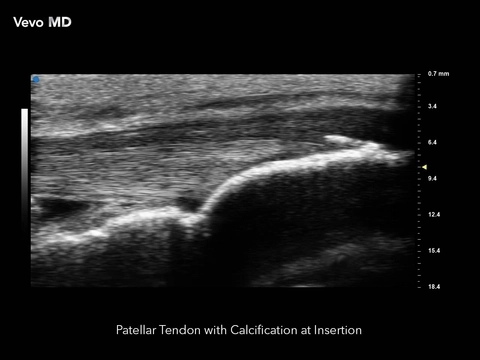 Vevo MD - Patellar Tendon with Calcification.jpg