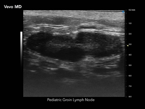 Vevo MD - Pediatric Lymph Node.jpg