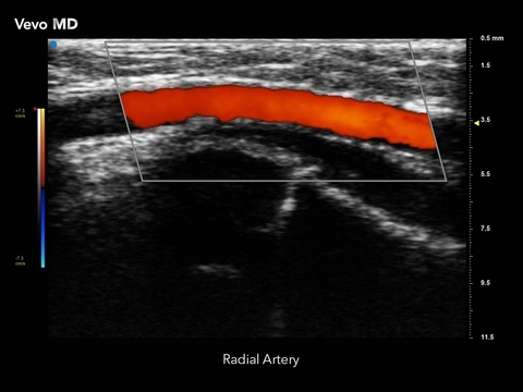 Vevo MD - Radial Artery.jpg