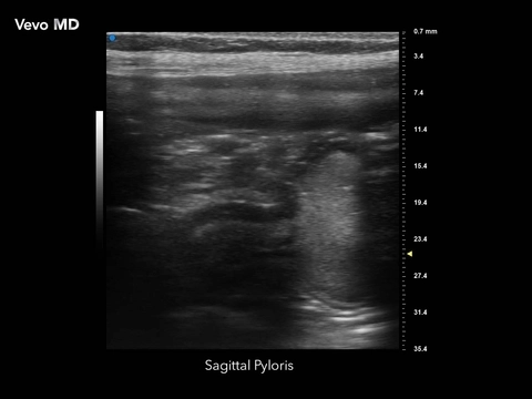 Vevo MD - Sagittal Pyloris.jpg