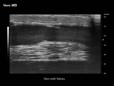 Vevo MD - Vein with Valves.jpg