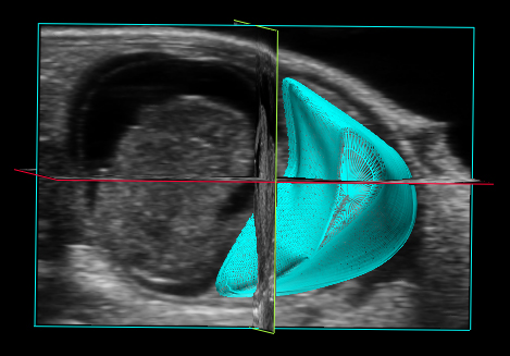 3D-Reconstruction-of-Placenta.jpg