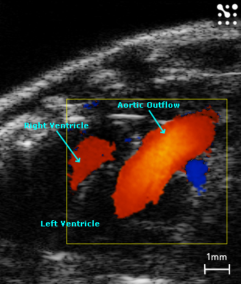 Acending Aorta from a Parasternal Notch View
