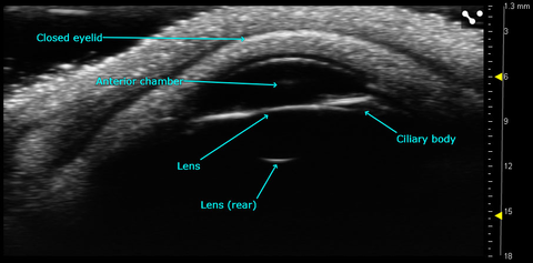 Anterior chamber of the adult human eye imaged with the Vevo MD.jpg