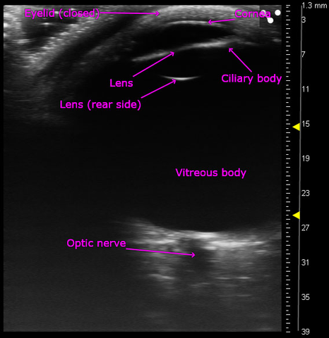 Entire adult human eye images with ultra high frequency ultrasound on the Vevo MD.jpg