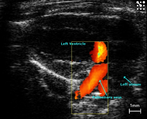 Left Atrium and Pulmonary Veins