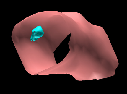 Mouse Colon Tumor 3D overlay.jpg