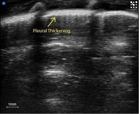 Rat Pleural Thickening.jpg