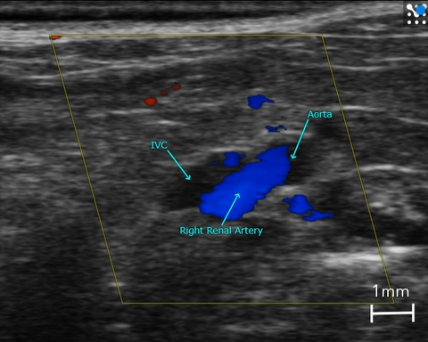 Major Abdominal Blood Vessels