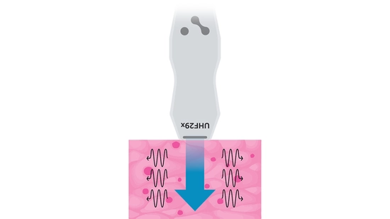 A UHF29x transducer sending shear waves via ultrasound push pulse(s).